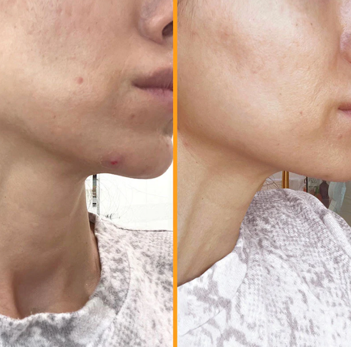 HAIRtamin SKINTAMIN : 1 MONTH SUPPLY : strongly supports skin firmness and elasticity and help reduce blemishes & breakouts, WITH ORIGINAL HOLOGRAM