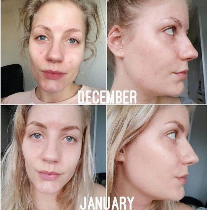 The ordinary niacinamide serum the ordinary - Achieve enchanting skin and face results with this duo and magic product
